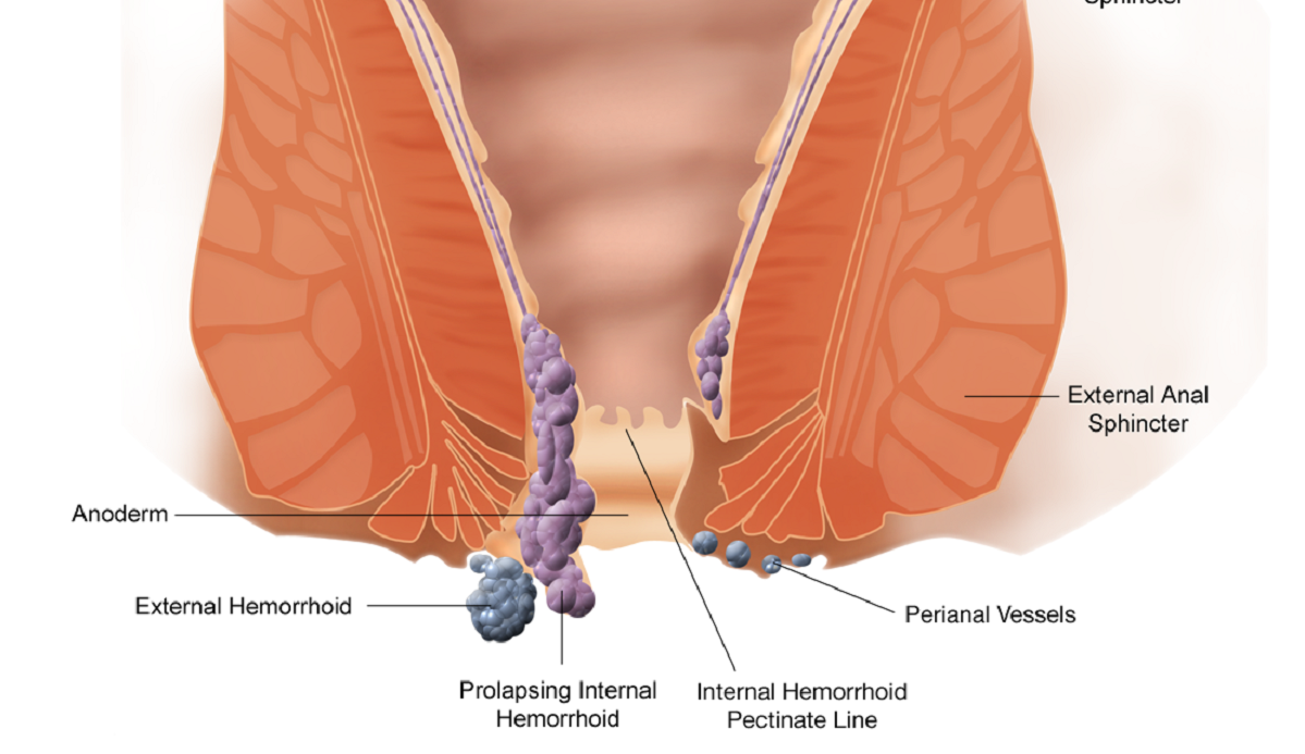 Emorroidi esterne