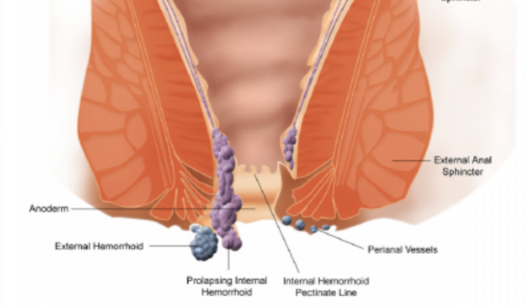 emorroidi esterne trombizzate
