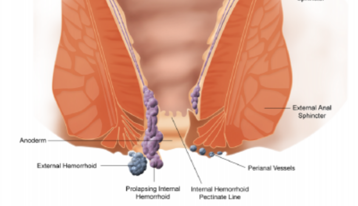 emorroidi esterne trombizzate