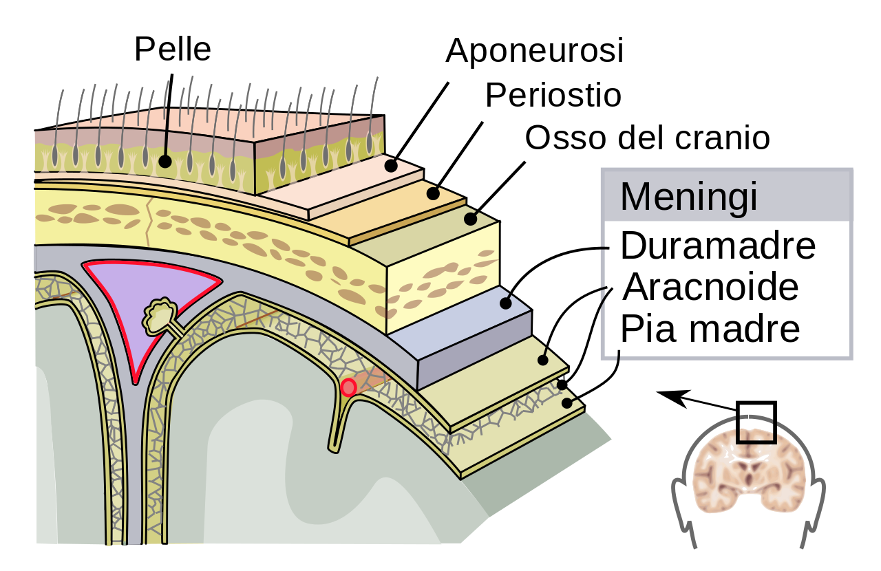 meningite