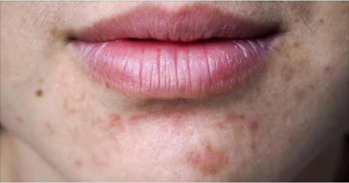 Come eliminare le macchie da acne con rimedi casalinghi Togliere le macchie