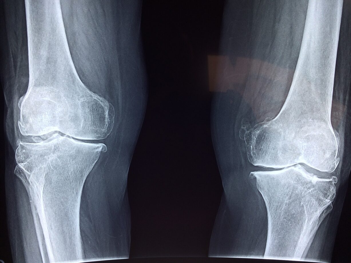lesioni al ginocchio