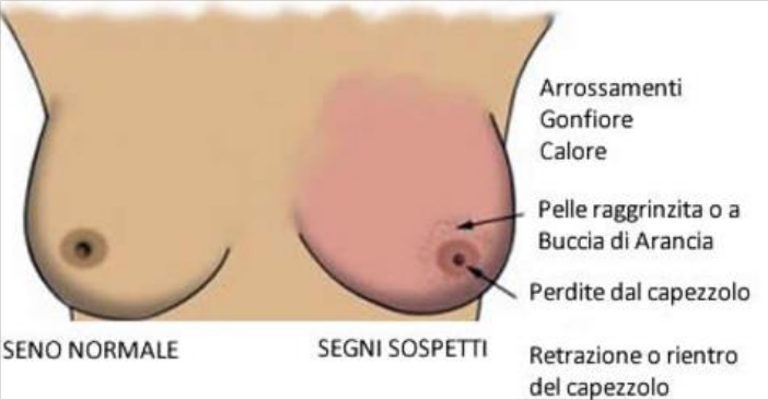 cancro al seno