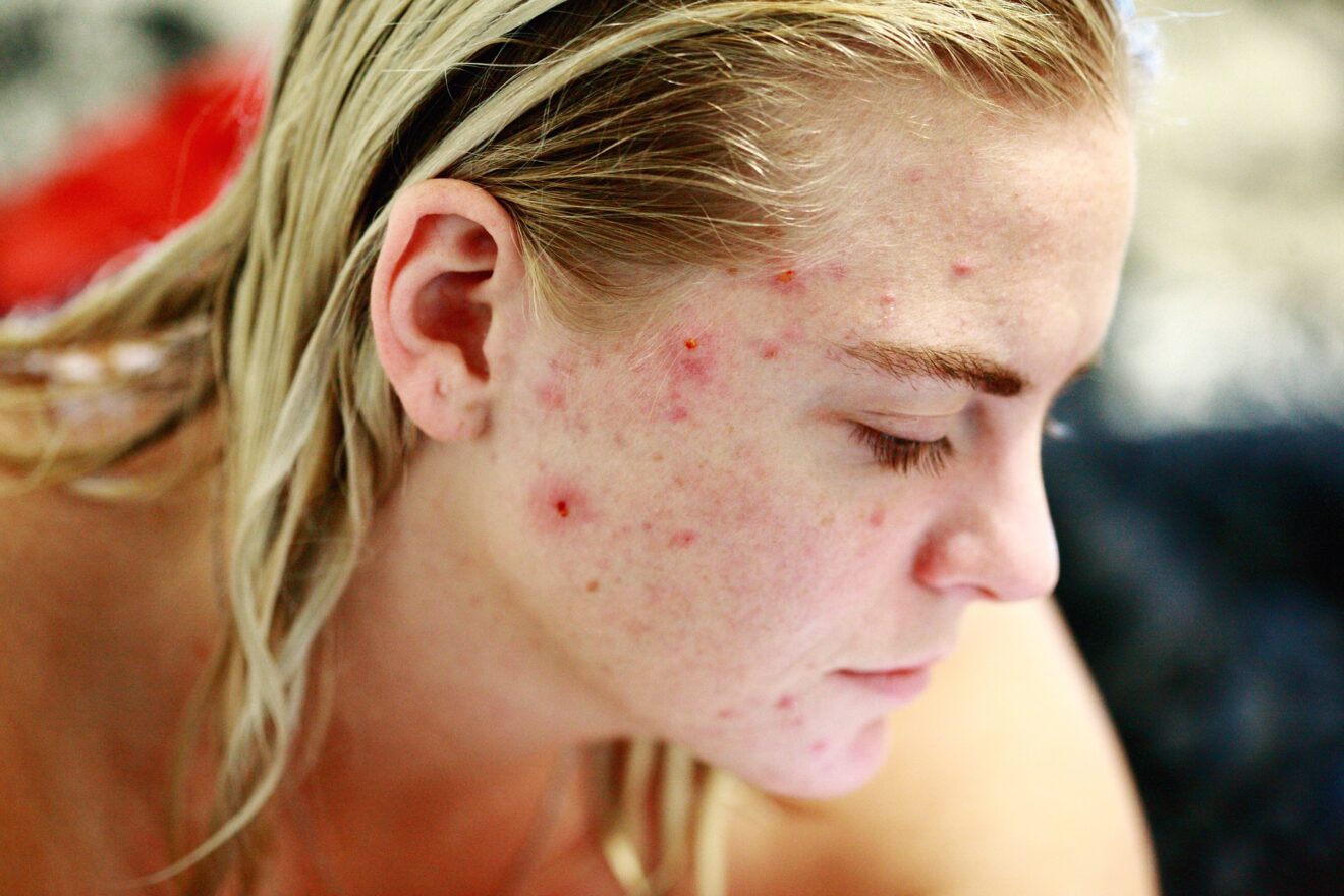 cicatrici da acne rimedi naturali