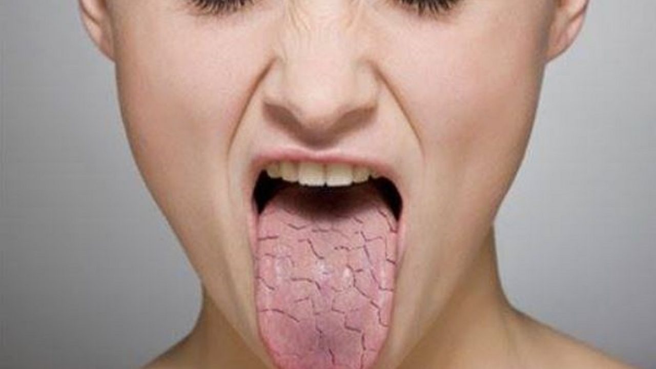 Лекарство при ксеростомии. Сухость во рту и в носу причины. Сухость ротовой полости. Жажда сухость во рту. Сухость во рту и в носу причины.