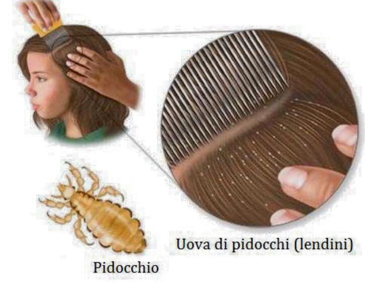 pediculosi