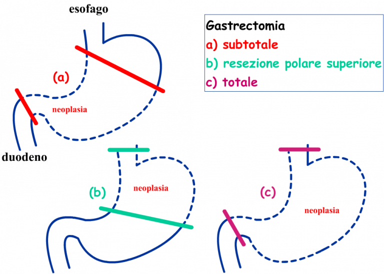 vivere senza stomaco