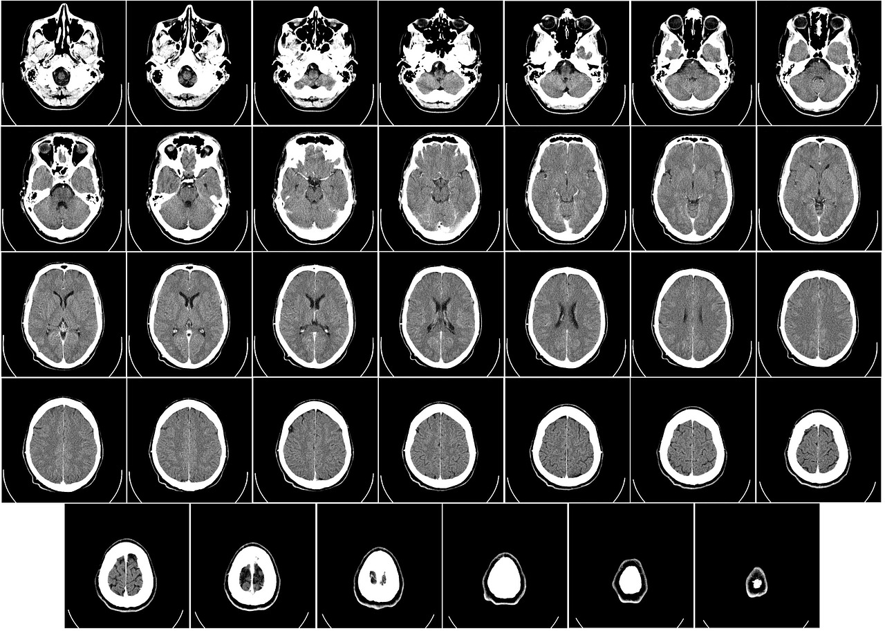 edema cerebrale