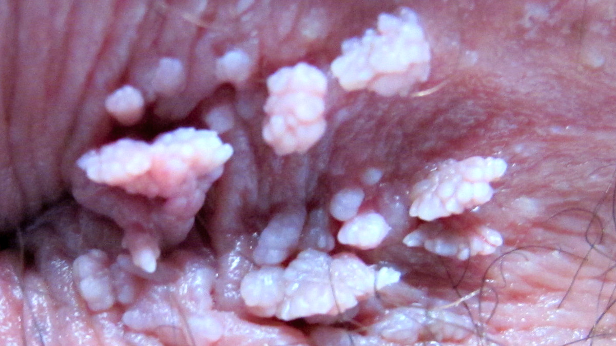 Papilloma virus uomo bocca - Nematode de clasă