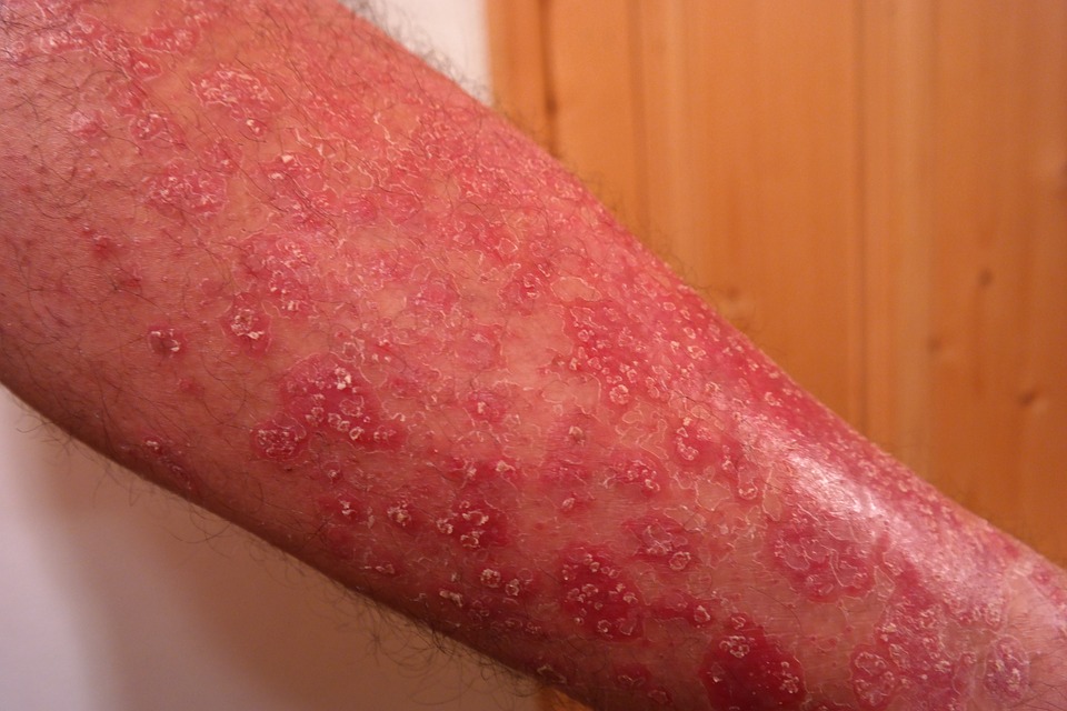 malattie sulla pelle