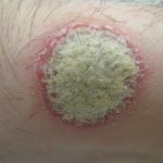 psoriasi
