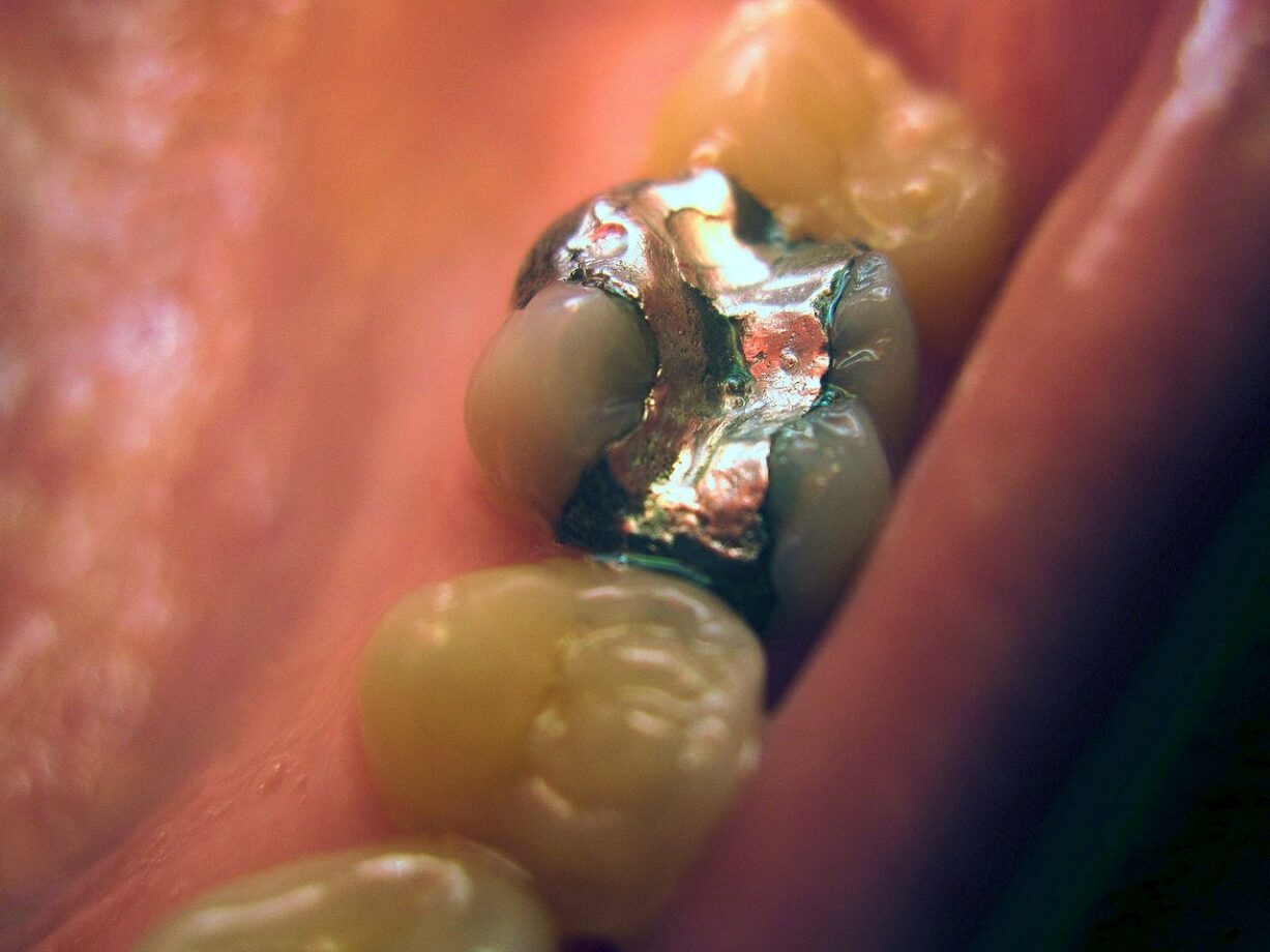 amalgama dentale