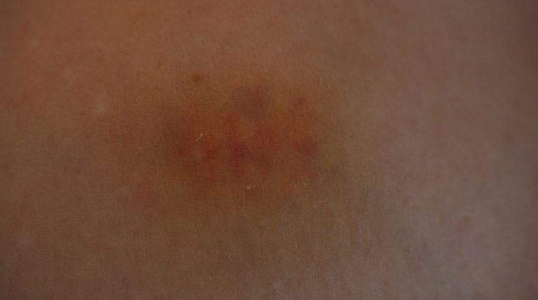 lividi gambe e braccia