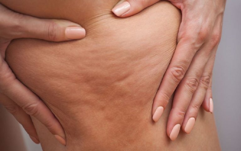rimedi naturali contro cellulite