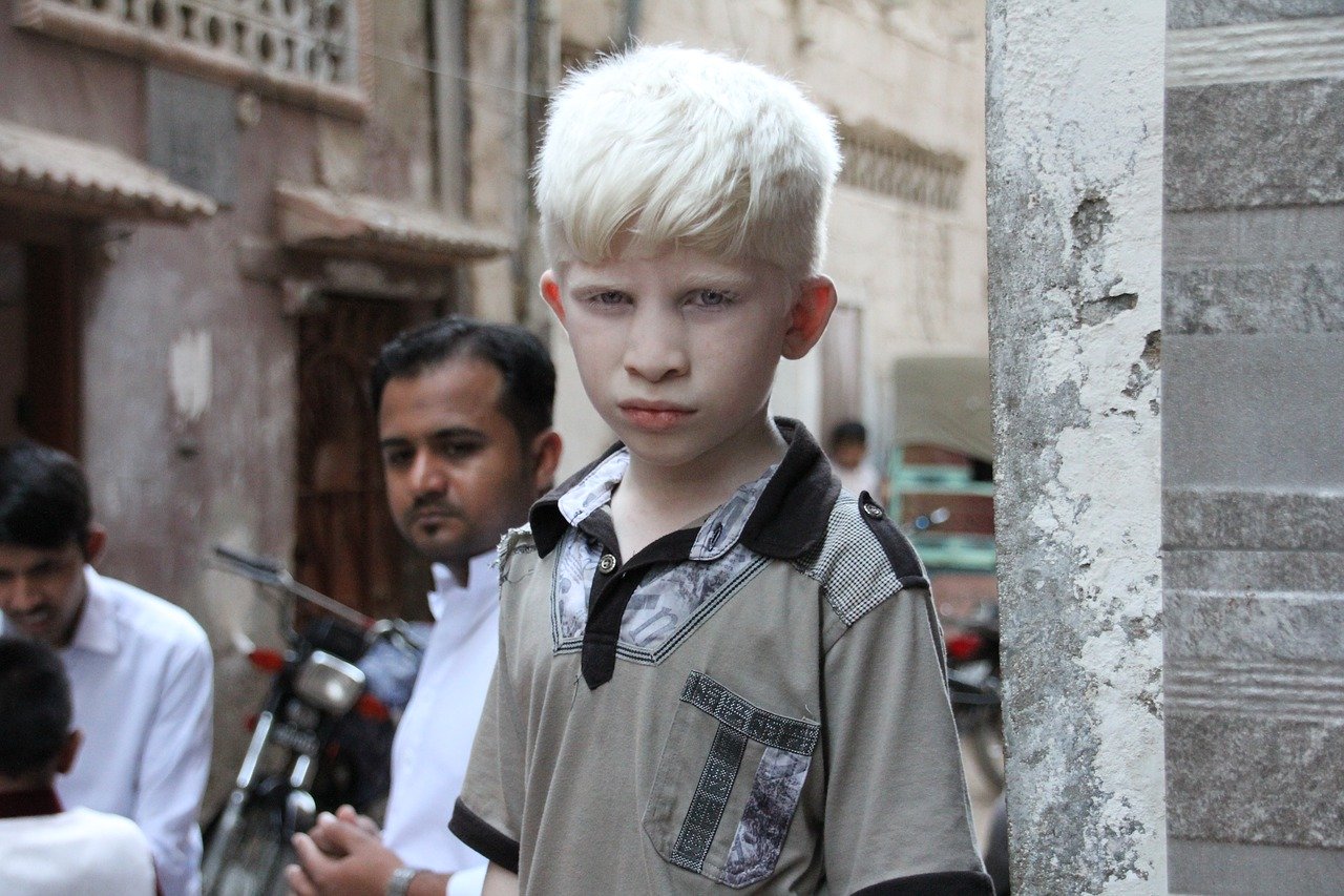 albinismo: cause e cos'è