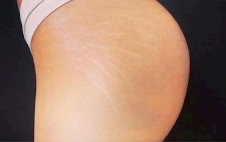 dermoabrasione cicatrici smagliature