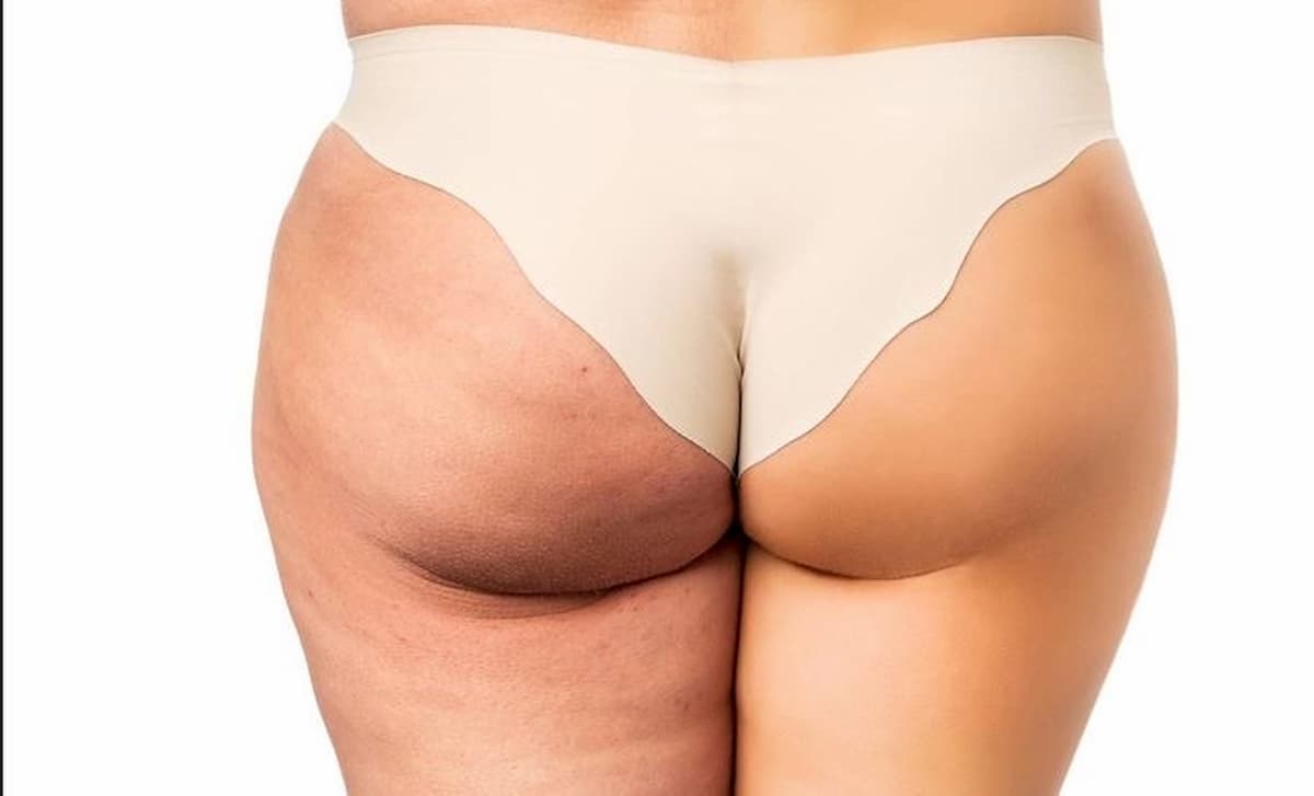 cellulite sclerotica