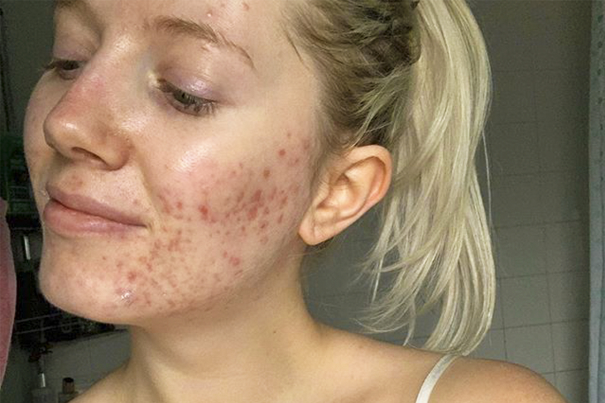 acne: cinque cose da sapere