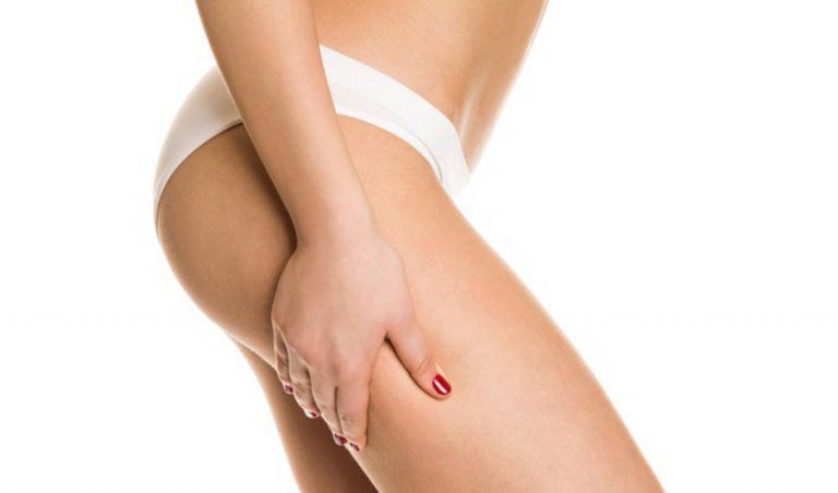 cellulite edematosa cause