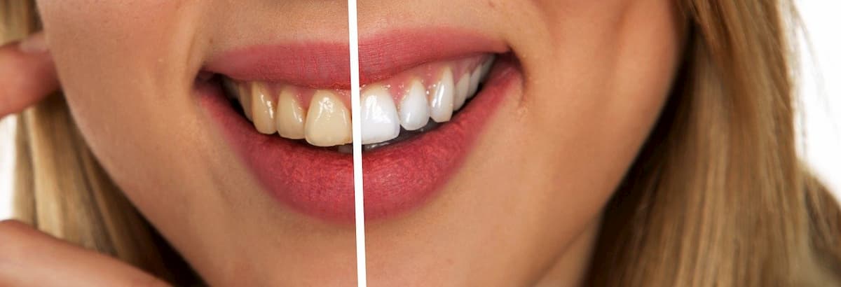 denti bianchi e sani