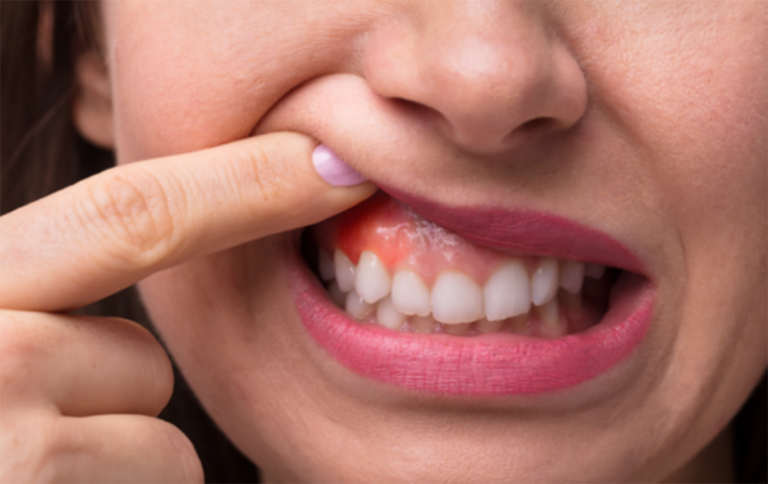 rimedi naturali gengive infiammate