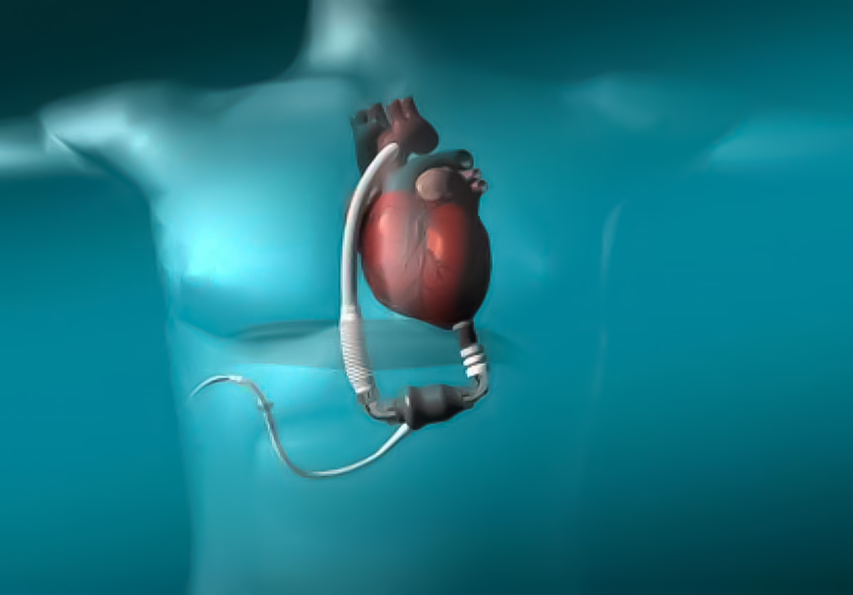 Ventricular Assist Device