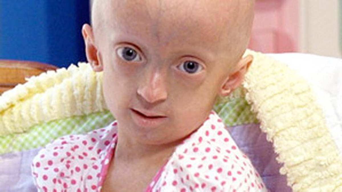 progeria cure