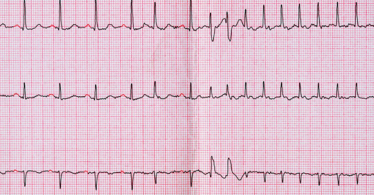 fibrillazione atriale