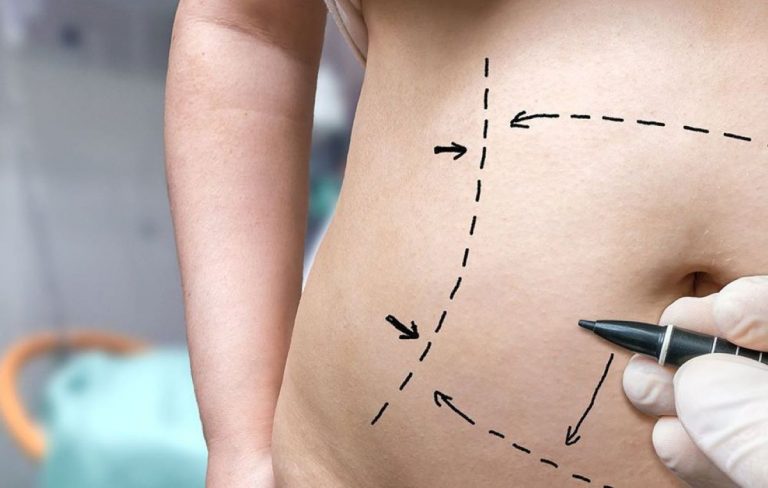 Liposcultura Hi Tech