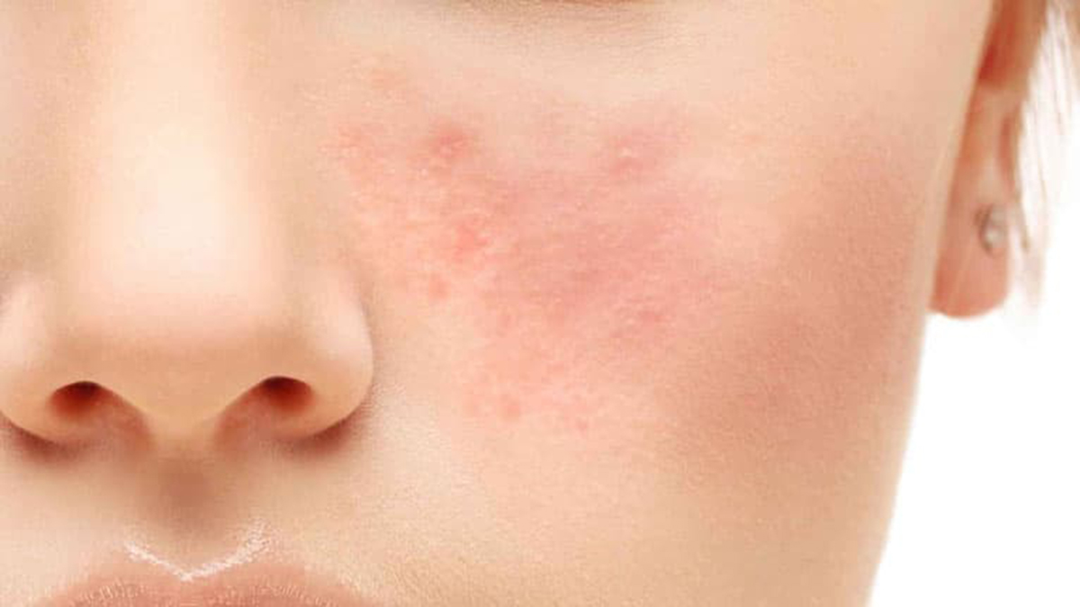 rosacea sintomi