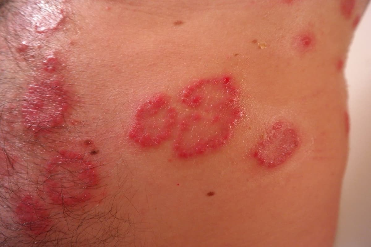 artrite psoriasica