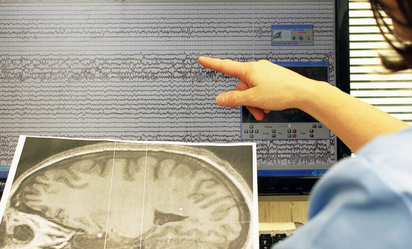 voce tremolante malattia neurodegenerativa