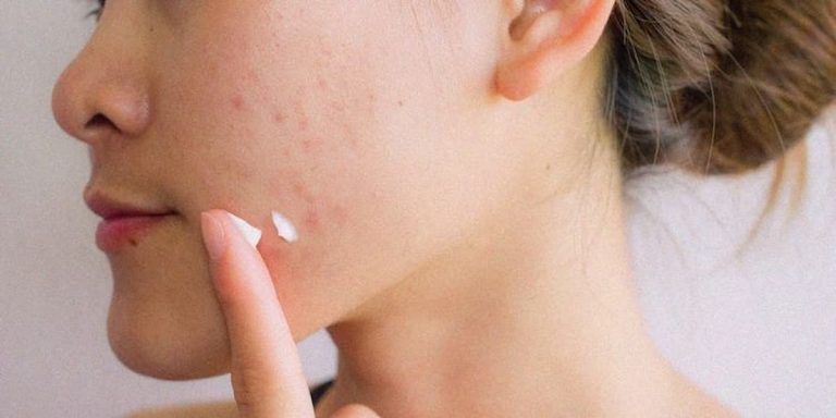acido azelaico acne brufoli