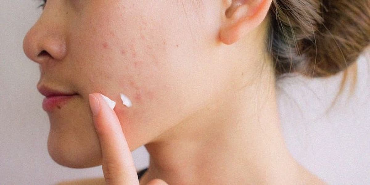 acido azelaico acne brufoli