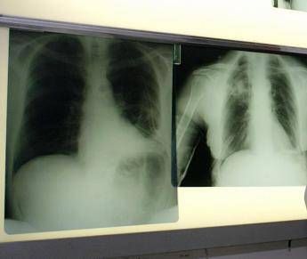 bpco ok dellema alla prima terapia con propellente green 2
