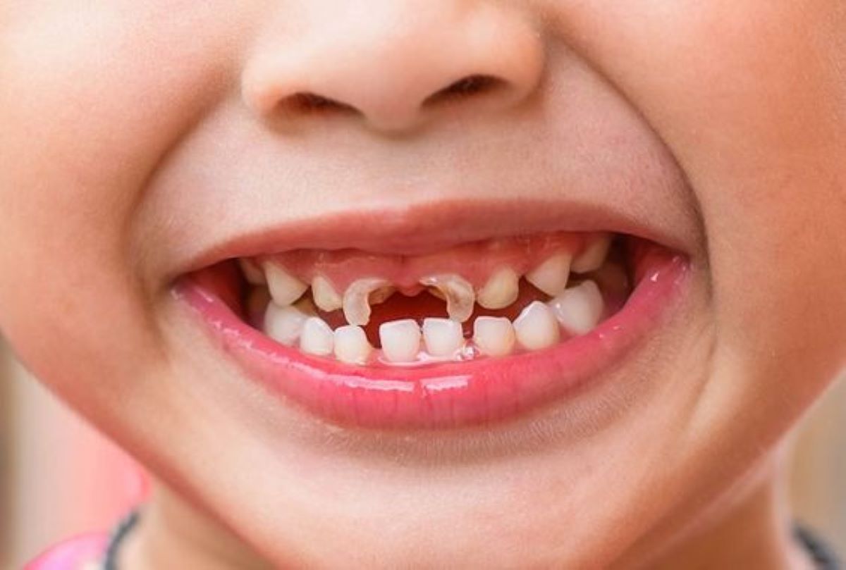 Cause dei denti di gesso nei bambini