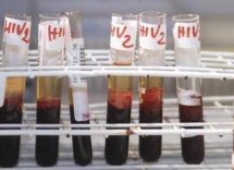 aids speranze da terapie long acting e prep il punto degli infettivologi simit 2