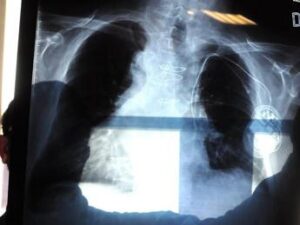 bpco pneumologa foschino barbaro nella donna sintomi diversi attenzione alle giovani 2
