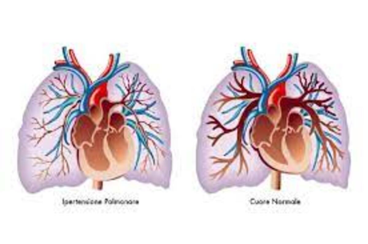 ipertensione polmonare