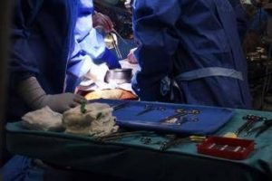 trapianti in italia record donazioni e scende attesa a milano congresso specialisti 2