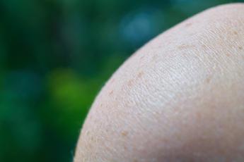 cose il melanoma sintomi prevenzione e successi dellimmunoterapia 2