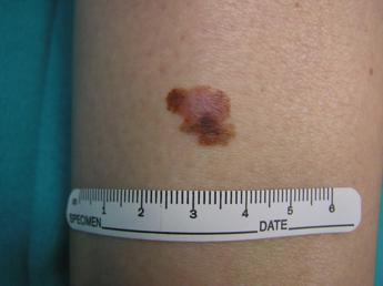 cancro oncologo tre anni per vaccino mrna contro melanoma 2