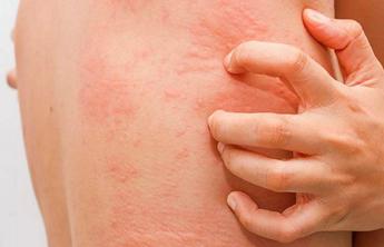 fake news sullorticaria limmunologo diffidare dai test farlocchi 2