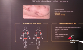 idrosadenite suppurativa lesperto piu attenzione a qualita della vita 2