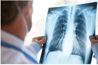 curare il cancro al polmone senza chirurgia prima italiana allieo di milano 3