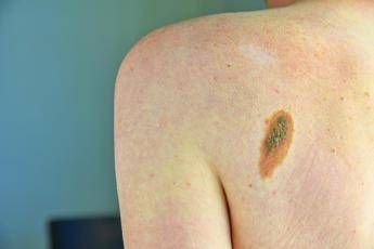 melanoma ascierto scito con immunoterapia piu speranze per meta forme gravi 2