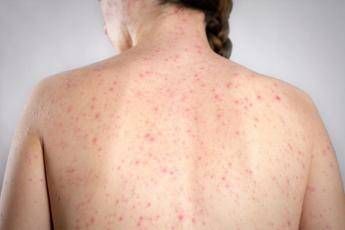 morbillo la verita sulla vitamina a non riduce il rischio di contrarre la malattia 2