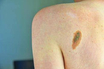 ok aifa a immunoterapia in fase precoce per melanoma e carcinoma polmonare 2