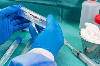 ricerca nella saliva 2 spie della demenza a corpi di lewy studio sapienza 2