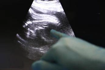 trapianti uk amy prima bimba nata da donazione di utero da vivente 2
